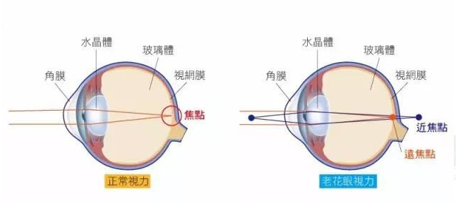 白內障和老花眼區別，老花眼發(fā)病率正呈現年輕化趨勢