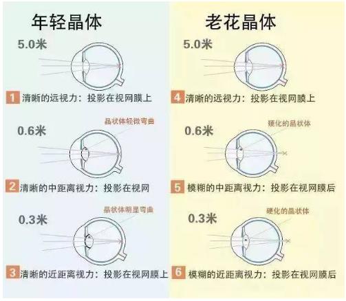 近視就不會(huì )老花了嗎？